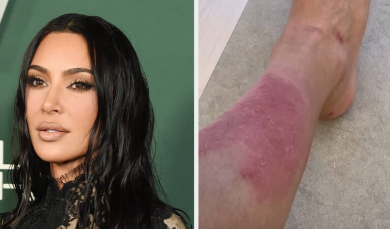 Kim Kardashian Shares Painful Psoriasis Flare Up, Praised
