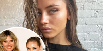 Heidi Klum's Model Daughter Leni Shares Makeup-Free Face Covered In Acne!